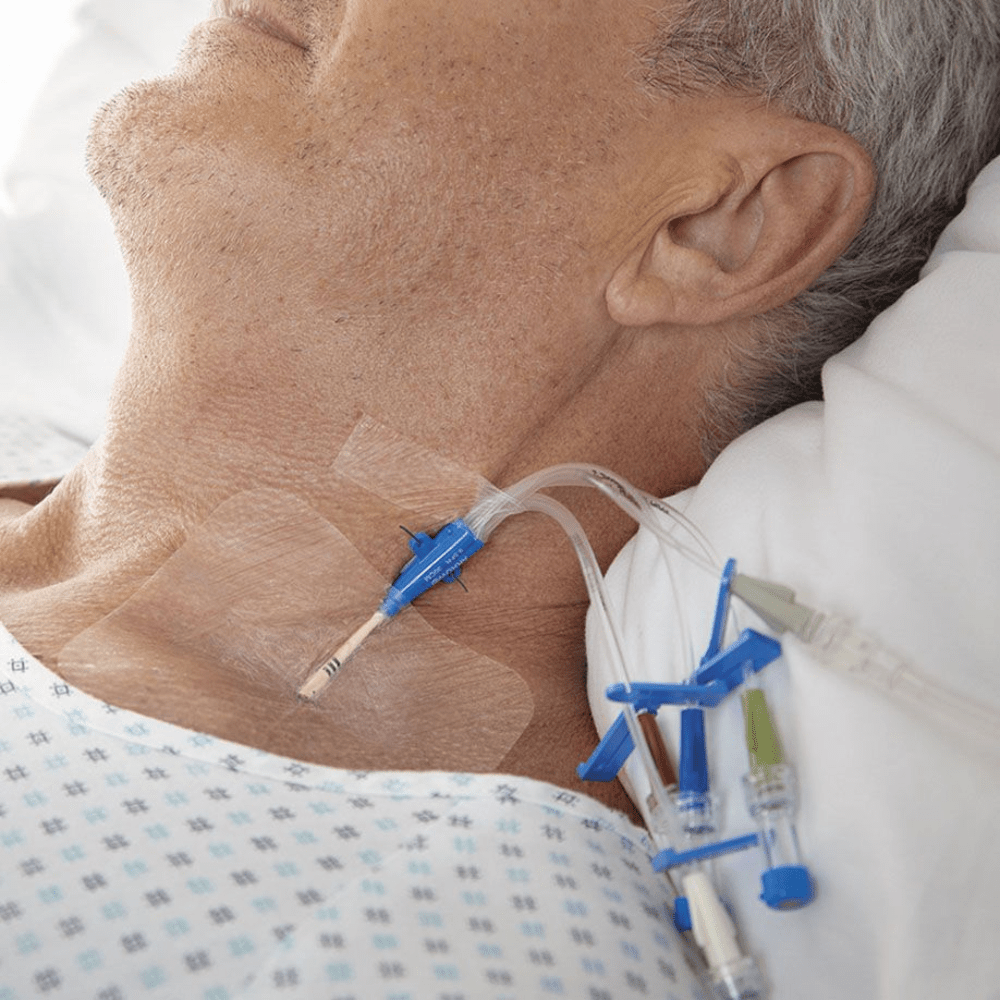 Eine Nahaufnahme eines Patienten zeigt einen in seinen Hals eingeführten zentralen Venenkatheter, der mit BSN Leukomed® T steriler, wasserdichter Wundverband 10 x 12,5 cm von BSN Medical GmbH zur sterilen Wundversorgung gesichert ist. Der Patient liegt auf einem Krankenhausbett und trägt ein gemustertes Nachthemd, umgeben von verschiedenen medizinischen Schläuchen und Verbindungsstücken.